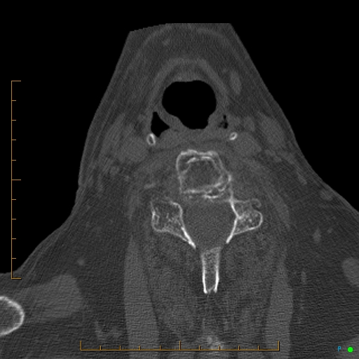 File:Cervical spine fracture - ankylosing spondylitis (Radiopaedia 76835-88706 Axial bone window 142).jpg