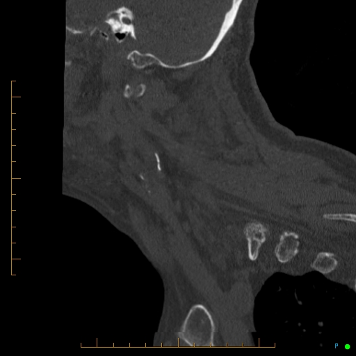 File:Cervical spine fracture - ankylosing spondylitis (Radiopaedia 76835-88706 Sagittal bone window 92).jpg