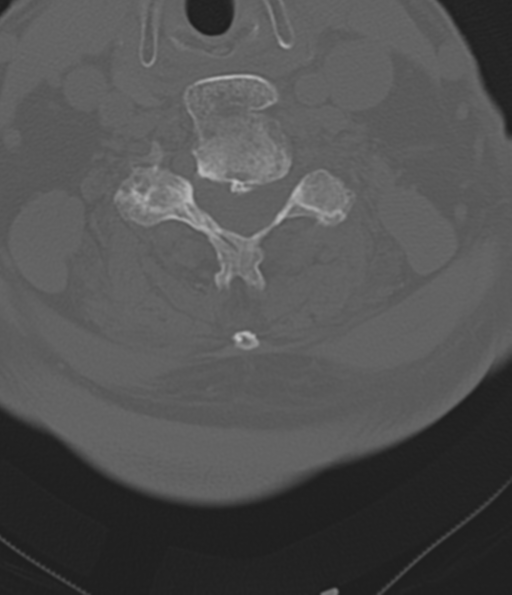 File:Cervical spine fracture in the setting of ankylosis (Radiopaedia 37038-38715 Axial bone window 37).png