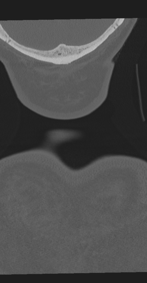 Cervical spine fracture in the setting of ankylosis (Radiopaedia 37038-38715 Coronal bone window 84).png