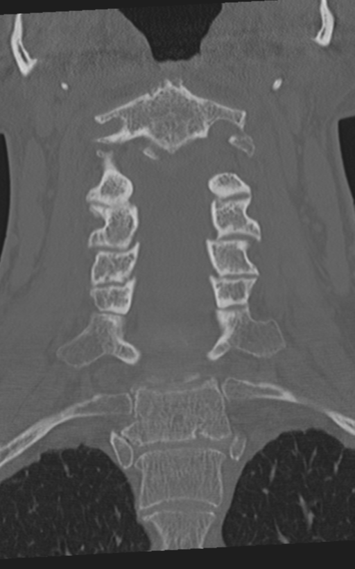 Cervical spine fractures with vertebral artery dissection (Radiopaedia 53296-59268 Coronal bone window 31).png