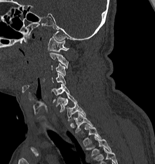 Cervical spine trauma with tear drop fracture and perched facet joint (Radiopaedia 53989-60127 Sagittal bone window 43).jpg
