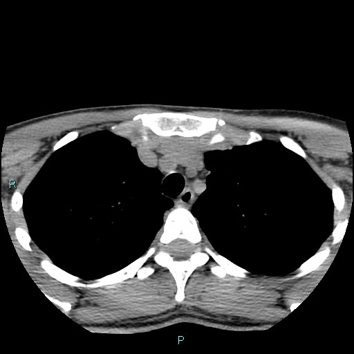 Cervical thymic cyst (Radiopaedia 88632-105335 Axial non-contrast 10).jpg