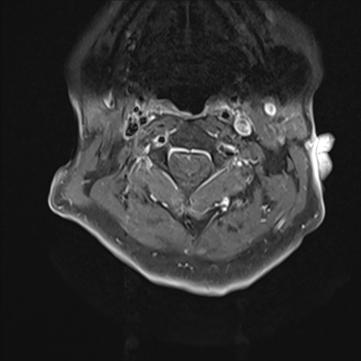 File:Cervical tumor-like myelopathy due to Type V dAVF (Radiopaedia 82461-96604 Axial T1 C+ fat sat 9).jpg