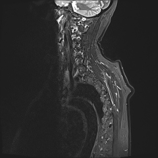 File:Cervical tumor-like myelopathy due to Type V dAVF (Radiopaedia 82461-96604 Sagittal STIR 17).jpg