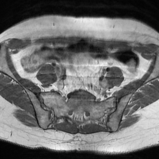 File:Cesarian section scar endometriosis (Radiopaedia 66520-75799 Axial T1 1).jpg