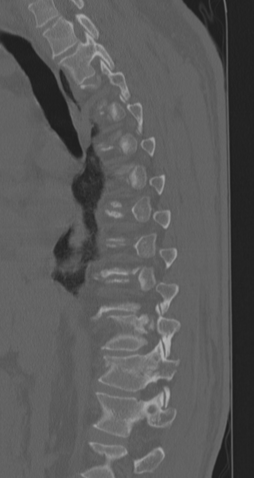 Chance fracture (Radiopaedia 33854-35020 Sagittal bone window 55).png