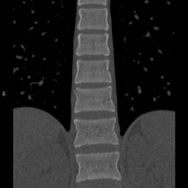 File:Chance fracture (Radiopaedia 36521-38081 Coronal bone window 24).jpg