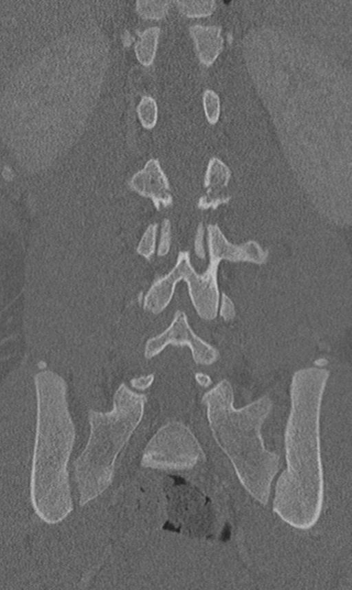 Chance fracture (Radiopaedia 40360-42912 Coronal bone window 44).png