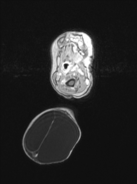 Chiari III malformation with occipital encephalocele (Radiopaedia 79446-92559 Axial T1 C+ mpr 20).jpg