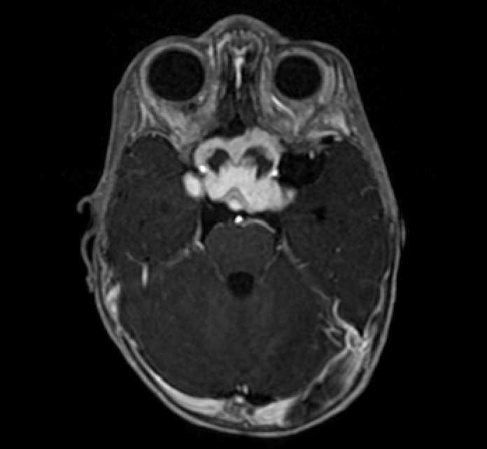 Chiasmatic-hypothalamic glioma (Radiopaedia 90079-107252 Axial T1 C+ 25).jpg