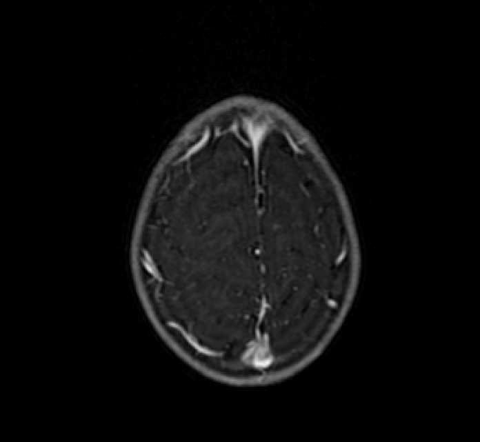 Chiasmatic-hypothalamic glioma (Radiopaedia 90079-107252 Axial T1 C+ 81).jpg