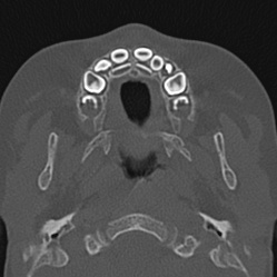 Choanal atresia (Radiopaedia 88525-105975 Axial bone window 2).jpg