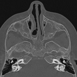 Choanal atresia (Radiopaedia 88525-105975 Axial bone window 40).jpg