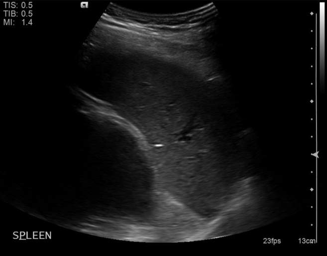 File:Cholecystitis - perforated gallbladder (Radiopaedia 57038-63913 A 19).jpg