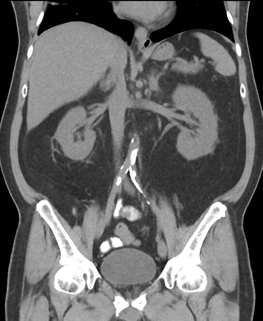 Cholecystitis with focal perforation and hepatic abscess (Radiopaedia 37189-38945 Coronal non-contrast 32).png