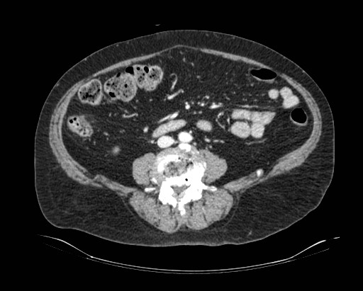 Cholecystoduodenal fistula (Radiopaedia 48959-54022 A 11).jpg