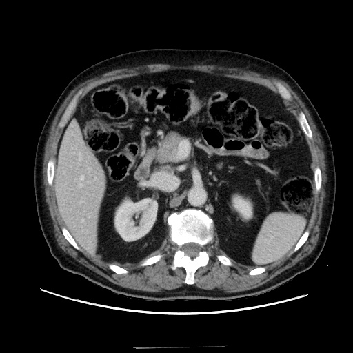 Choledocholiathiasis with normal caliber common bile duct (Radiopaedia 75368-86632 A 71).jpg