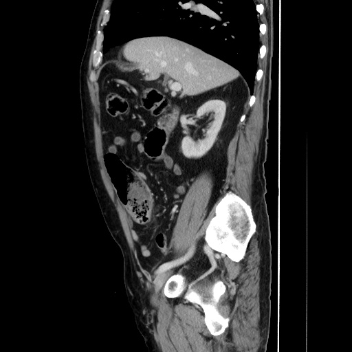 Choledocholiathiasis with normal caliber common bile duct (Radiopaedia 75368-86632 D 61).jpg