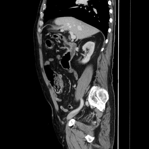 Choledocholiathiasis with normal caliber common bile duct (Radiopaedia 75368-86632 D 64).jpg