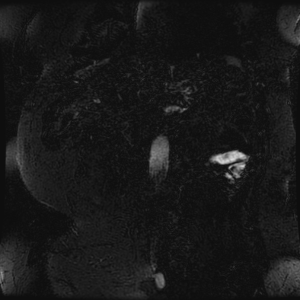Choledocholithiasis on CT and MRI (Radiopaedia 24825-25088 Coronal T2 111).jpg