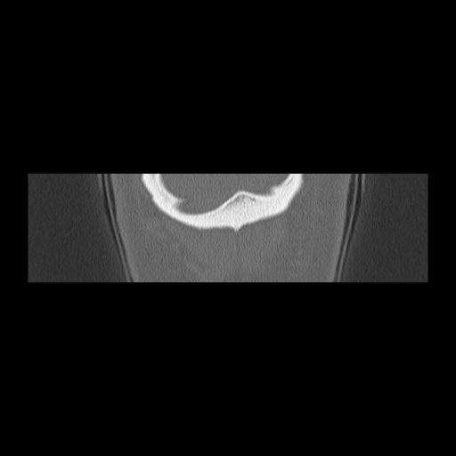 Cholesteatoma (Radiopaedia 84946-100455 Coronal bone window 164).jpg