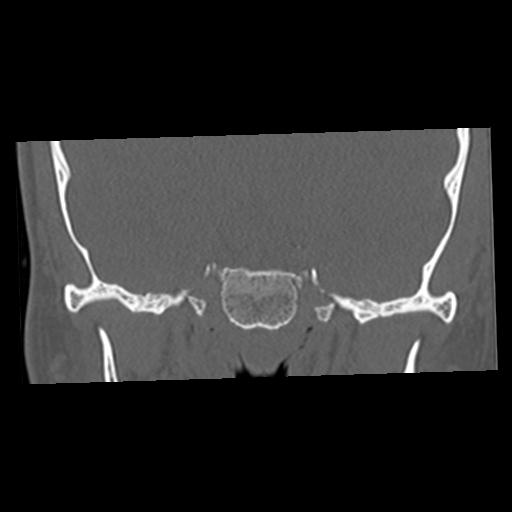 Cholesteatoma (Radiopaedia 84960-100474 Coronal bone window 16).jpg