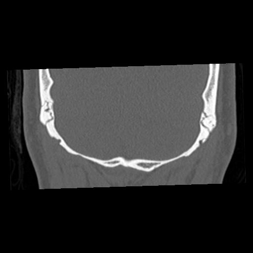 Cholesteatoma (Radiopaedia 84960-100474 Coronal bone window 72).jpg