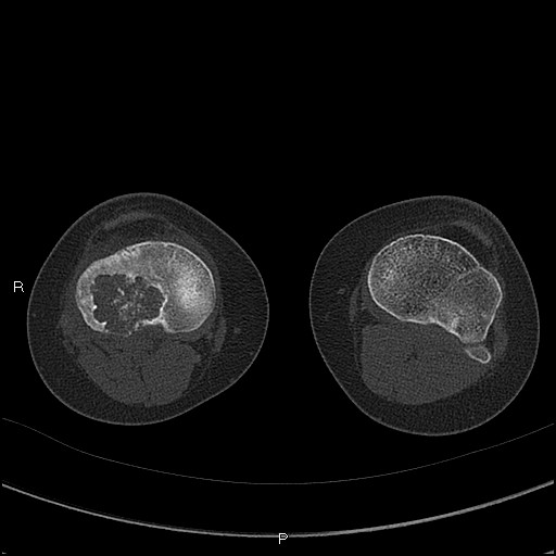 Chondroblastoma (Radiopaedia 62721-71030 Axial bone window 51).jpg