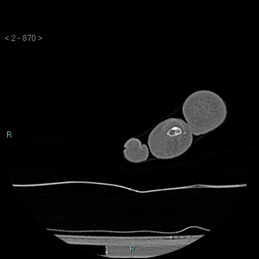Chondrosarcoma - phalanx (Radiopaedia 69047-78812 Axial bone window 124).jpg