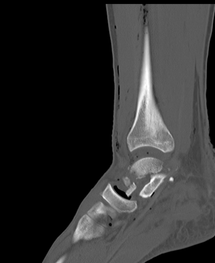 Chopart fracture (Radiopaedia 35347-36851 Sagittal bone window 36).jpg