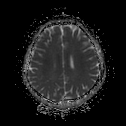 File:Chordoid glioma of third ventricle (Radiopaedia 91612-109340 Axial ADC 20).jpg