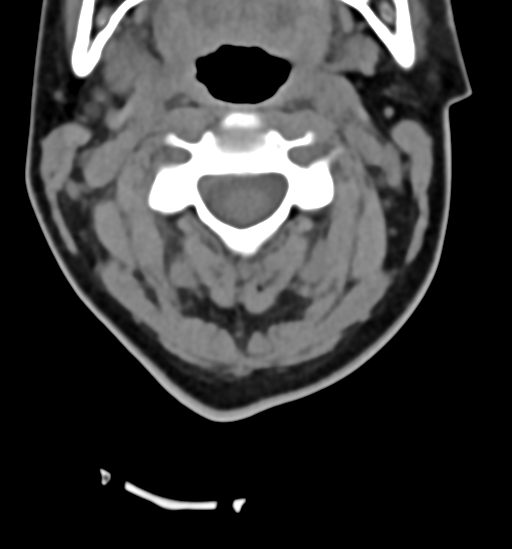 File:Chordoma (C4 vertebra) (Radiopaedia 47561-52188 Axial non-contrast 18).png