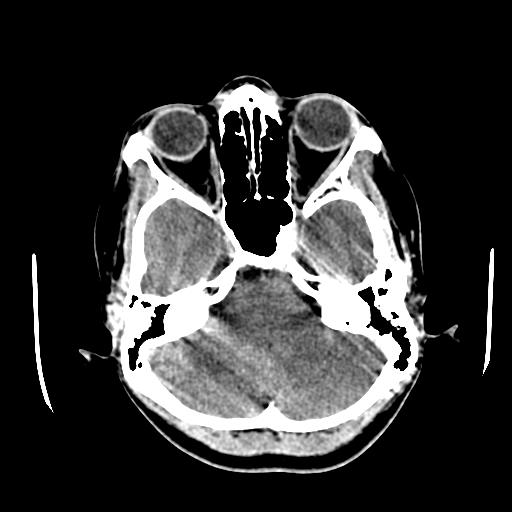 File:Choriocarcinoma of ovary with cerebral and pulmonary metastases (Radiopaedia 25983-26118 C+ arterial phase 32).jpg