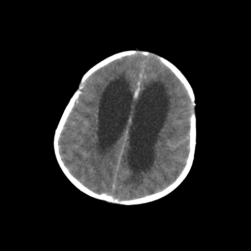 Choroid plexus papilloma (Radiopaedia 63946-72698 Axial with contrast 55).jpg