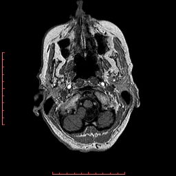 Choroid plexus xanthogranuloma (Radiopaedia 67843-77270 Axial T1 148).jpg