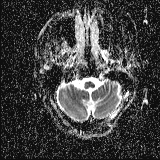 File:Choroid plexus xanthogranuloma - unilateral (Radiopaedia 85632-101393 Axial ADC 9).jpg