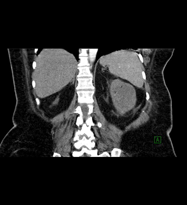 Chromophobe renal cell carcinoma (Radiopaedia 84239-99519 C 66).jpg