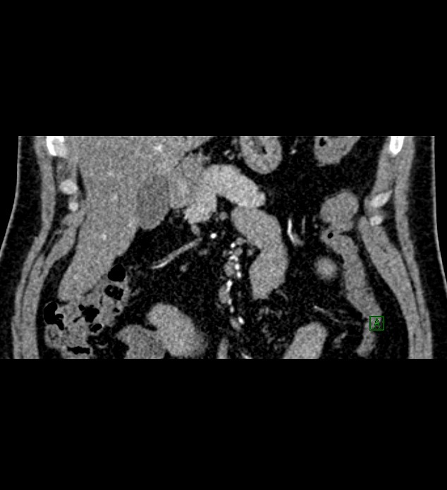 Chromophobe renal cell carcinoma (Radiopaedia 84286-99573 E 7).jpg