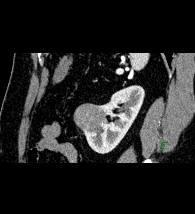 Chromophobe renal cell carcinoma (Radiopaedia 84286-99573 F 42).jpg