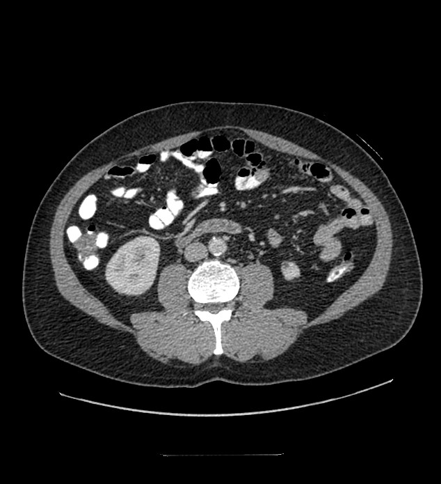 Chromophobe renal cell carcinoma (Radiopaedia 84337-99644 C 70).jpg