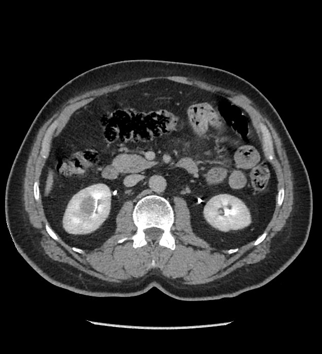 Chromophobe renal cell carcinoma (Radiopaedia 86879-103083 D 61).jpg