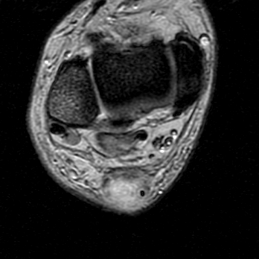File:Chronic Achilles tendon rupture (Radiopaedia 15262-15100 Axial Gradient Echo 12).jpg