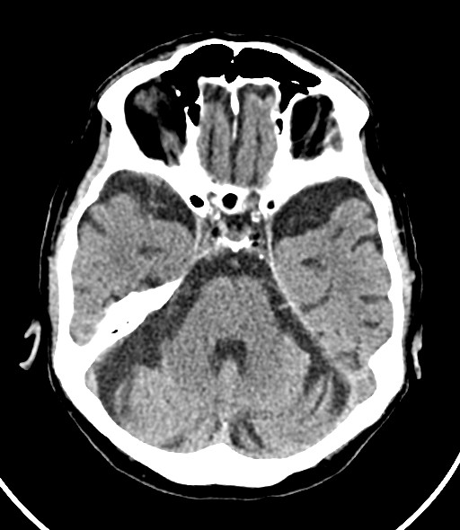 Chronic bilateral subdural hygroma (Radiopaedia 85801-101623 Axial non-contrast 43).jpg