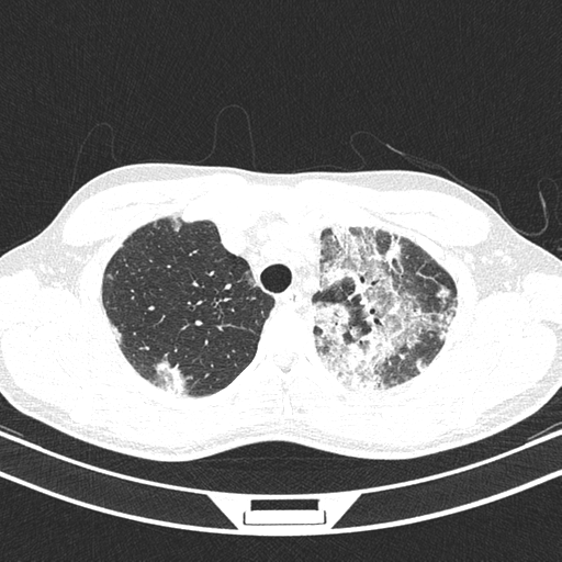 Chronic eosinophilic pneumonia (Radiopaedia 39331-41587 Axial lung window 11).png