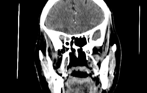 Chronic invasive fungal sinusitis (Radiopaedia 91563-109286 D 68).jpg