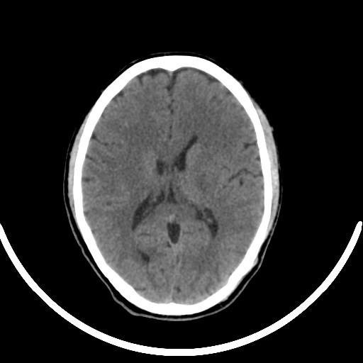 Chronic invasive fungal sinusitis with intraorbital and intracranial extension (Radiopaedia 56387-63046 Axial non-contrast 221).jpg