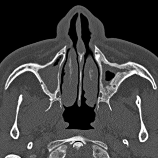 Chronic maxillary sinusitis (Radiopaedia 27879-28116 Axial bone window 12).jpg