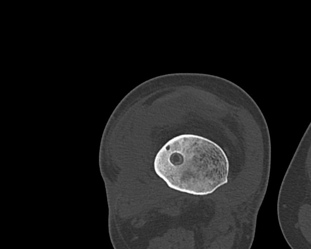 File:Chronic ostemyelitis of the femur with long sinus tract (Radiopaedia 74947-85982 Axial bone window 188).jpg