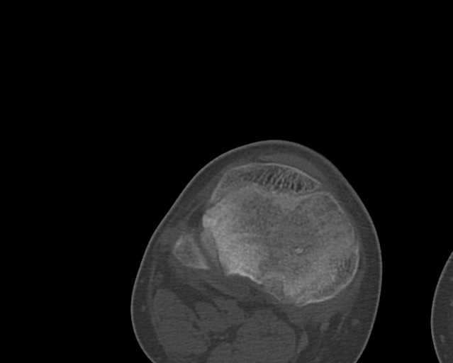 Chronic ostemyelitis of the femur with long sinus tract (Radiopaedia 74947-85982 Axial bone window 239).jpg